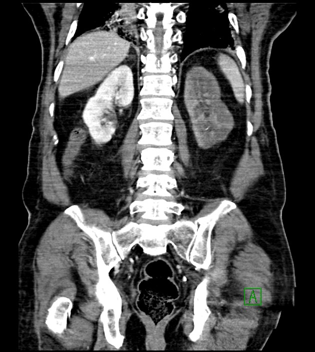 Acute arterial mesenteric ischemia (Radiopaedia 78238-90828 Coronal C+ portal venous phase 67).jpg
