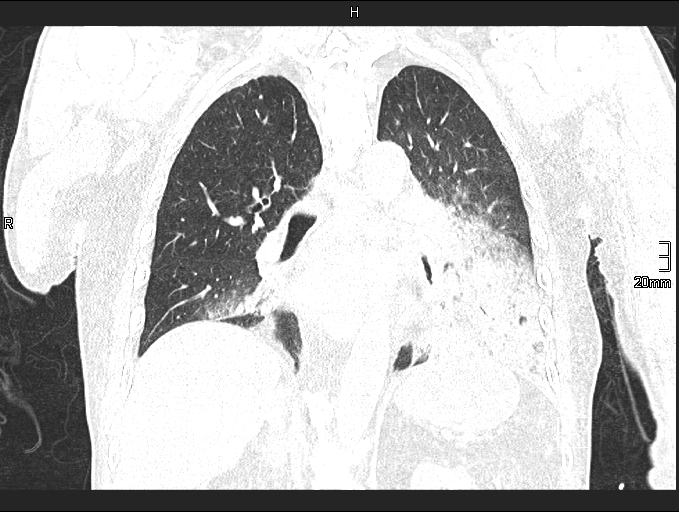 File:Acute aspiration pneumonitis (Radiopaedia 55642-62166 Coronal lung window 63).jpg