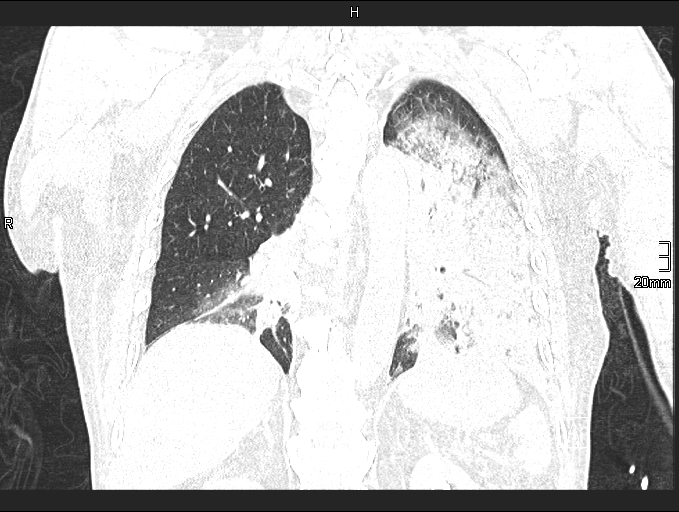 Acute aspiration pneumonitis (Radiopaedia 55642-62166 Coronal lung window 69).jpg