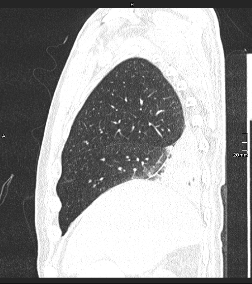 Acute aspiration pneumonitis (Radiopaedia 55642-62166 Sagittal lung window 123).jpg