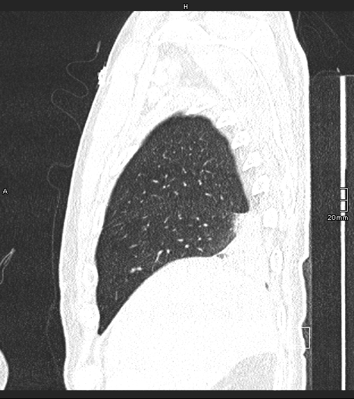 Acute aspiration pneumonitis (Radiopaedia 55642-62166 Sagittal lung window 132).jpg