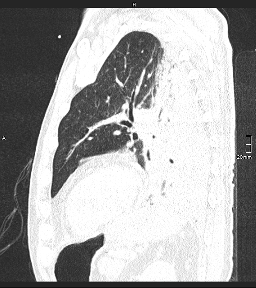 Acute aspiration pneumonitis (Radiopaedia 55642-62166 Sagittal lung window 43).jpg