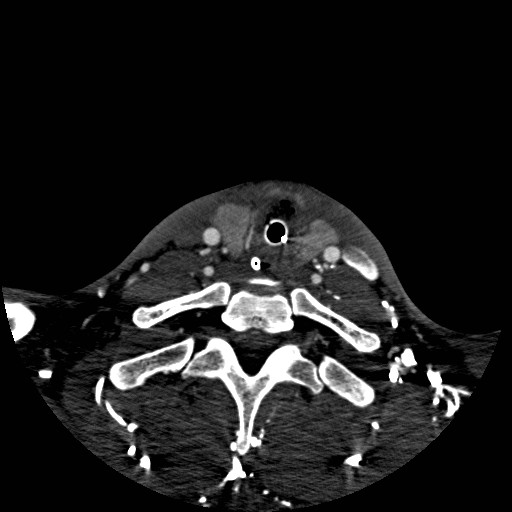 Acute basilar artery occlusion (Radiopaedia 43582-46985 Axial C+ arterial phase 266).jpg