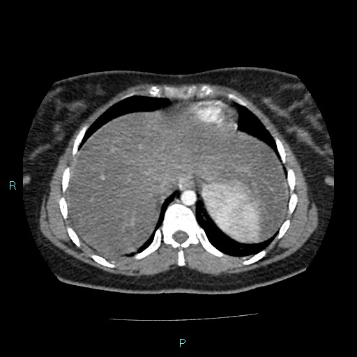 Acute bilateral pyelonephritis (Radiopaedia 37146-38881 Axial C+ arterial phase 15).jpg