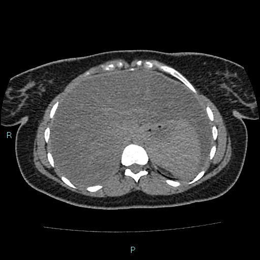 Acute bilateral pyelonephritis (Radiopaedia 37146-38881 Axial non-contrast 18).jpg