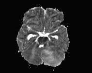 File:Acute cerebellar ataxia (Radiopaedia 61487-69446 Axial ADC 6).jpg
