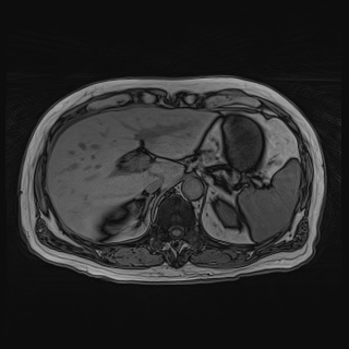 Acute cholecystitis (Radiopaedia 72392-82923 Axial T1 out-of-phase 41).jpg