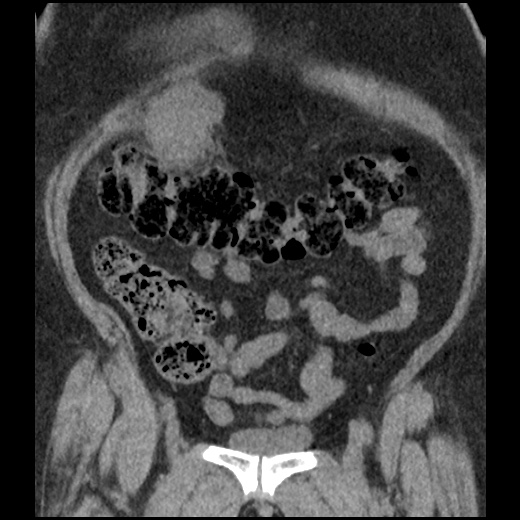 Acute cholecystitis and ureteric colic (Radiopaedia 42330-45444 Coronal prone 31).jpg
