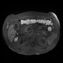 File:Acute cholecystitis complicated by pylephlebitis (Radiopaedia 65782-74915 Axial T1 fat sat 65).jpg