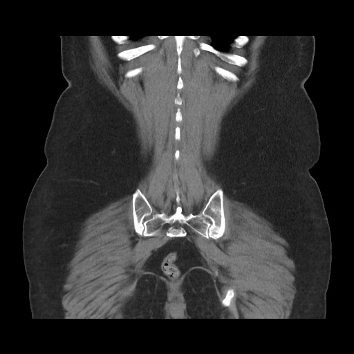 Acute cholecystitis with tensile fundus sign (Radiopaedia 71394-81723 Coronal non-contrast 101).jpg