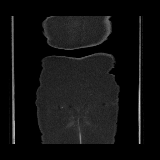 Acute cholecystitis with tensile fundus sign (Radiopaedia 71394-81723 Coronal non-contrast 123).jpg