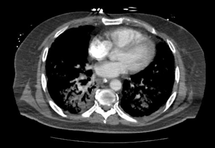 File:Acute cor pulmonale (ultrasound) (Radiopaedia 83508-98818 Axial C+ CTPA 47).jpg