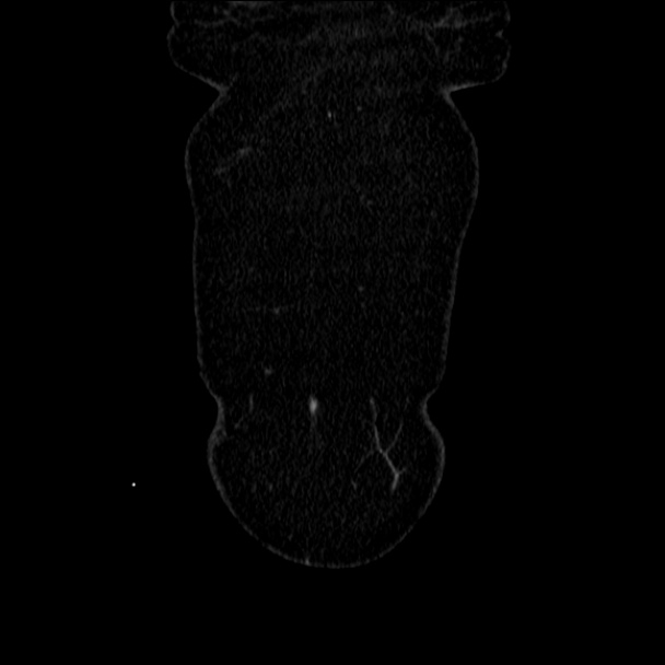 Acute diverticulitis (Radiopaedia 34183-35442 Coronal C+ portal venous phase 7).jpg