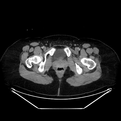 Acute diverticulitis - transverse colon (Radiopaedia 87063-103327 Axial C+ portal venous phase 167).jpg