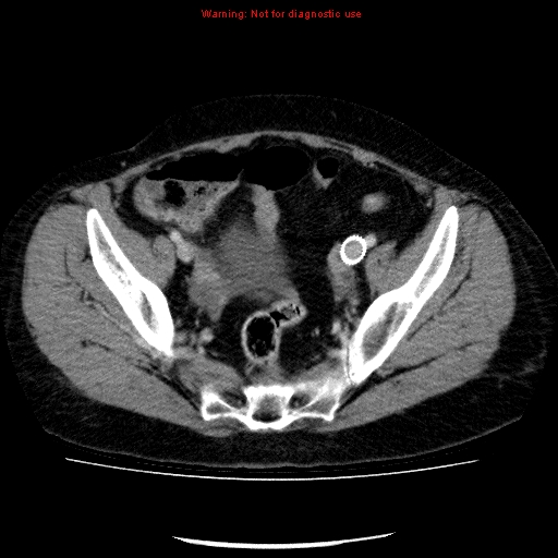 Acute gangrenous cholecystitis (Radiopaedia 10123-10661 Axial C+ portal venous phase 85).jpg