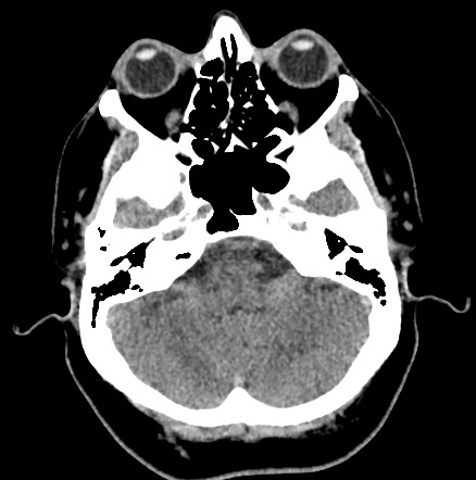 Acute internal carotid artery dissection (Radiopaedia 53541-59558 Axial non-contrast 13).jpg