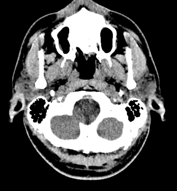 Acute ischemic stroke - posterior circulation territory (Radiopaedia 77670-89881 non-contrast 6).jpg