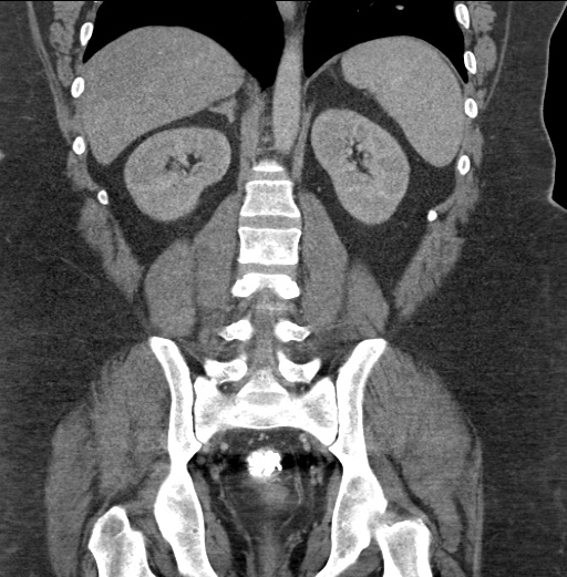Acute mesenteric venous ischemia (Radiopaedia 46041-50383 Coronal C+ portal venous phase 65).jpg