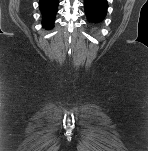 Acute mesenteric venous ischemia (Radiopaedia 46041-50383 Coronal C+ portal venous phase 87).jpg