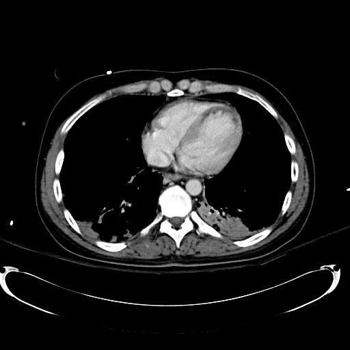 Acute myocardial infarction in CT (Radiopaedia 39947-42415 Axial C+ portal venous phase 5).jpg