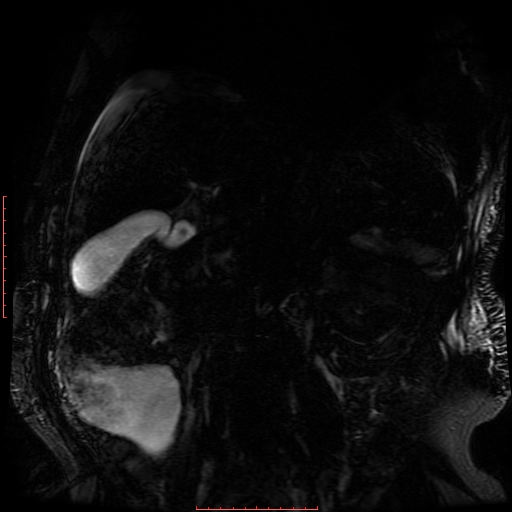 Acute necrotizing pancreatitis (Radiopaedia 28194-28448 Coronal MRCP 28).jpg