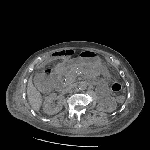 Acute on chronic pancreatitis (Radiopaedia 13233-13244 Axial non-contrast 39).jpg