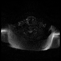 Acute otitis externa (Radiopaedia 57296-64236 Axial DWI 56).jpg