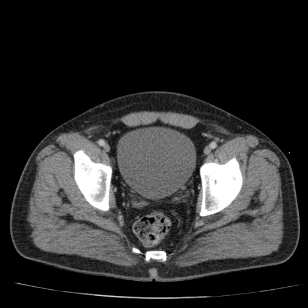 Acute pancreatitis (Radiopaedia 26663-26813 Axial C+ portal venous phase 79).jpg
