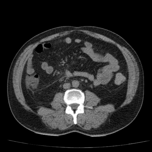Acute pancreatitis (Radiopaedia 26663-26813 Axial non-contrast 59).jpg