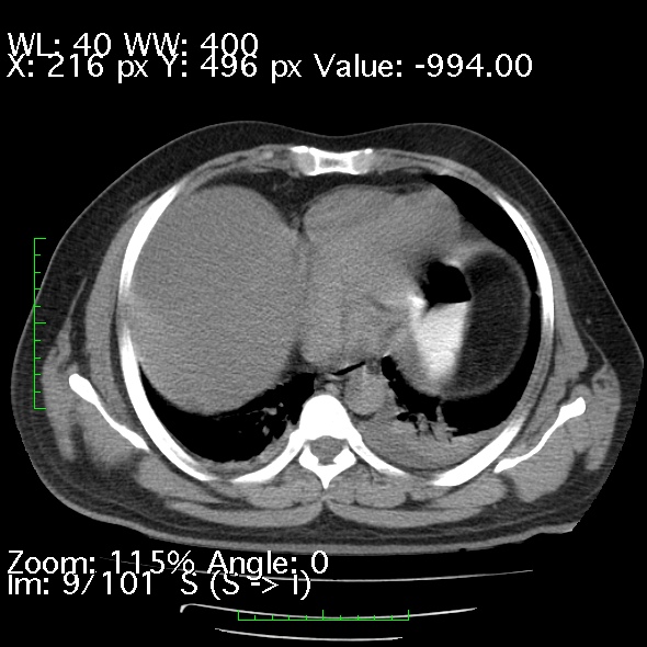Acute pancreatitis (Radiopaedia 34043-35276 Axial non-contrast 9).jpg