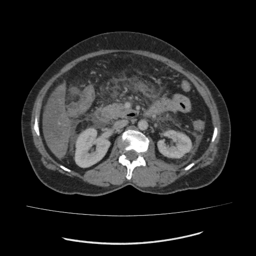 Acute pancreatitis (Radiopaedia 80007-93285 Axial C+ portal venous phase 78).jpg