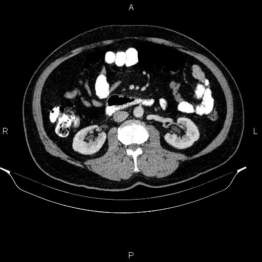 Acute pancreatitis (Radiopaedia 85390-101010 Axial C+ portal venous phase 51).jpg