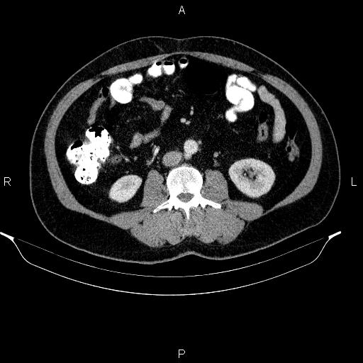 Acute pancreatitis (Radiopaedia 85390-101010 Axial C+ portal venous phase 58).jpg