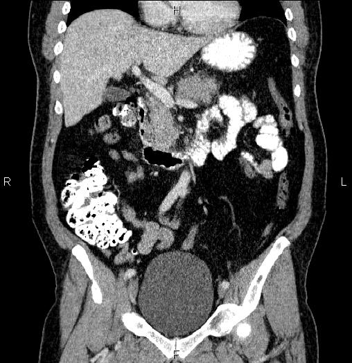 Acute pancreatitis (Radiopaedia 85390-101010 Coronal C+ portal venous phase 30).jpg