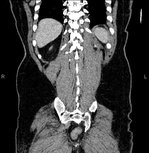 Acute pancreatitis (Radiopaedia 85390-101010 Coronal C+ portal venous phase 64).jpg