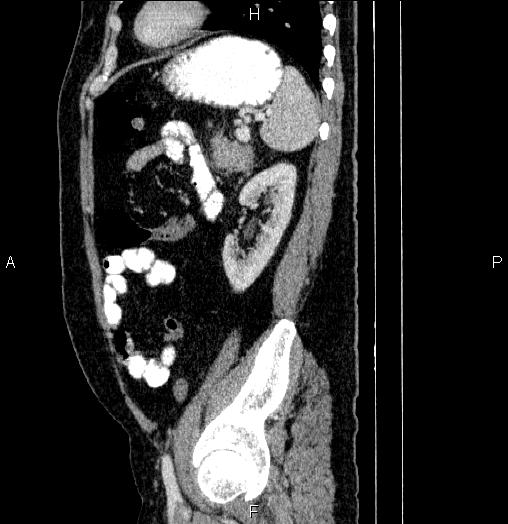 Acute pancreatitis (Radiopaedia 85390-101010 Sagittal C+ portal venous phase 77).jpg