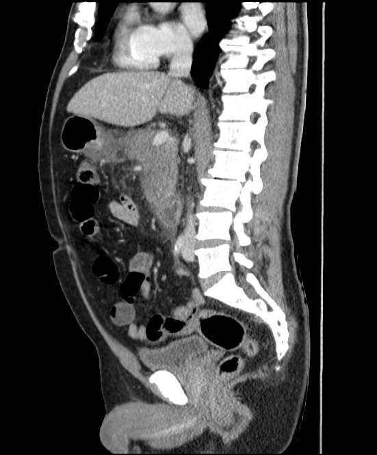 Acute pancreatitis - Balthazar E (Radiopaedia 23080-23110 Sagittal C+ portal venous phase 46).jpg