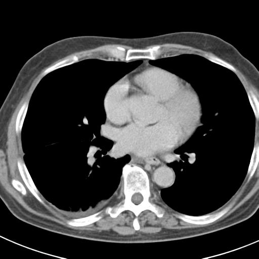 Acute pancreatitis and walled-off necrosis (Radiopaedia 29888-30403 Axial C+ delayed 1).jpg