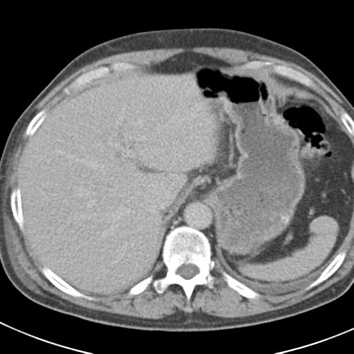 File:Acute pancreatitis and walled-off necrosis (Radiopaedia 29888-30403 Axial C+ delayed 18).jpg