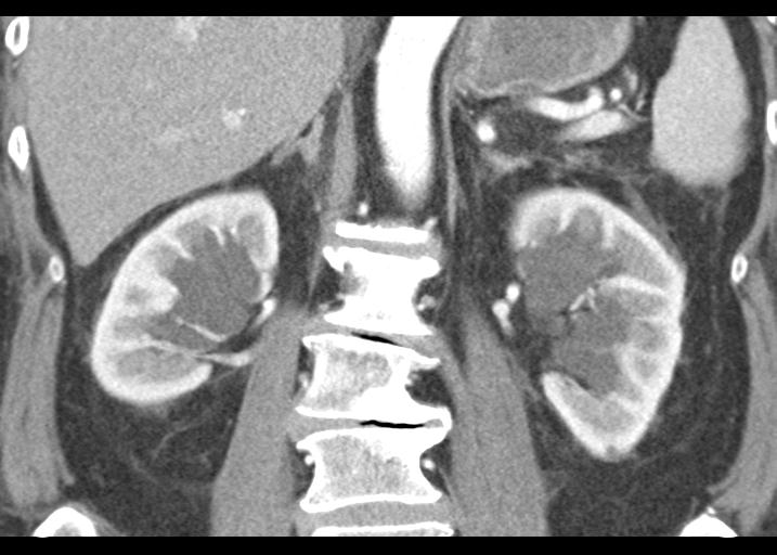 Acute pancreatitis and walled-off necrosis (Radiopaedia 29888-30403 Coronal C+ portal venous phase 37).jpg