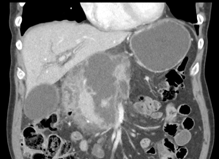 Acute pancreatitis and walled-off necrosis (Radiopaedia 29888-30404 Coronal C+ portal venous phase 20).jpg