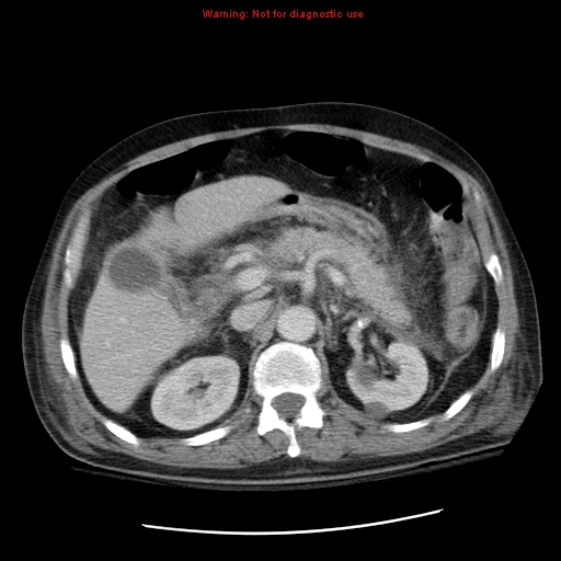 File:Acute pancreatitis with incidental pancreatic lipoma (Radiopaedia 10190-10730 Axial C+ portal venous phase 23).jpg