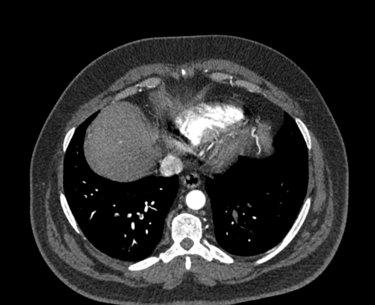 Acute pulmonary embolism with pulmonary infarcts (Radiopaedia 77688-89908 Axial C+ CTPA 51).jpg
