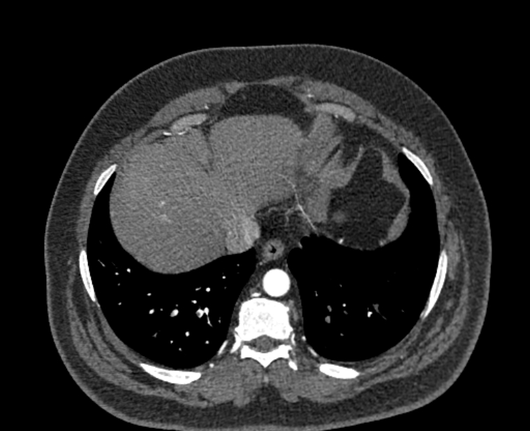 Acute pulmonary embolism with pulmonary infarcts (Radiopaedia 77688-89908 Axial C+ CTPA 54).jpg