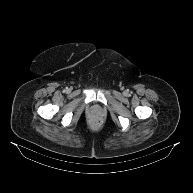 Acute pyelonephritis (Radiopaedia 25657-25837 Axial renal parenchymal phase 82).jpg