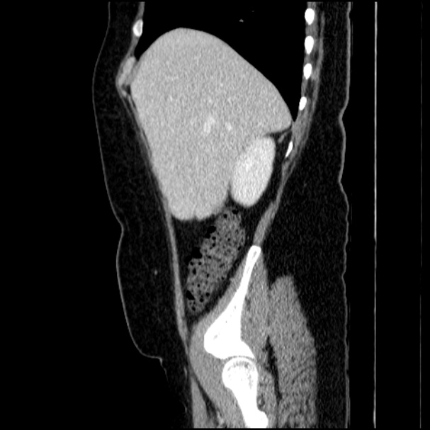 Acute pyelonephritis (Radiopaedia 33397-34434 Sagittal renal parenchymal phase 23).jpg