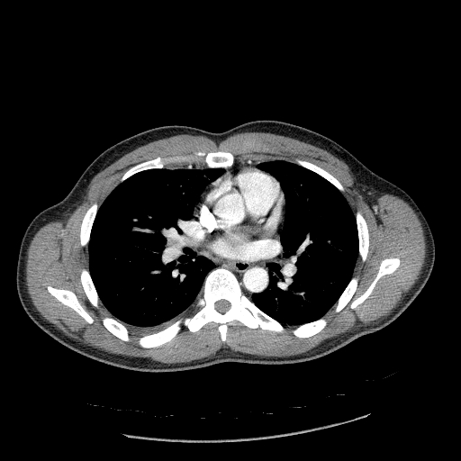 Acute segmental pulmonary emboli and pulmonary infarction (Radiopaedia 62264-70444 Axial C+ CTPA 57).jpg