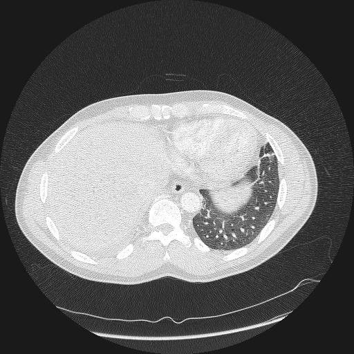 Acute segmental pulmonary emboli and pulmonary infarction (Radiopaedia 62264-70444 Axial lung window 160).jpg