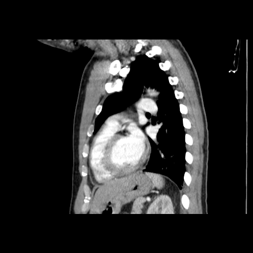 Acute segmental pulmonary emboli and pulmonary infarction (Radiopaedia 62264-70444 Sagittal C+ CTPA 44).jpg