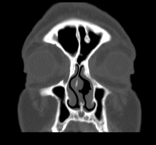 Acute sinusitis (Radiopaedia 23161-23215 Coronal bone window 23).jpg